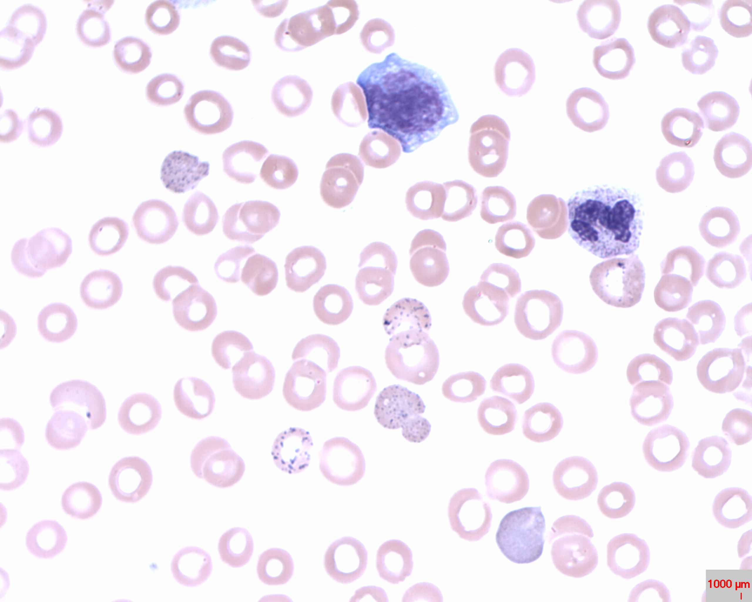 Basophilic stippling on peripheral blood smear