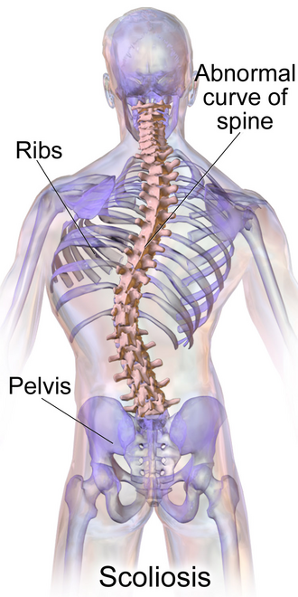 Scoliosis X-ray showing lateral curvature