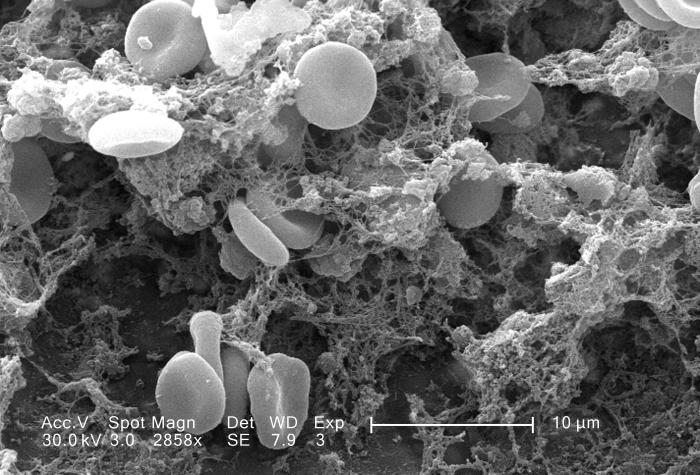 Blood clot scanning electron microscopy