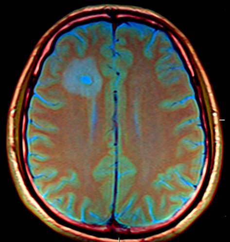Brain MRI showing metastasis