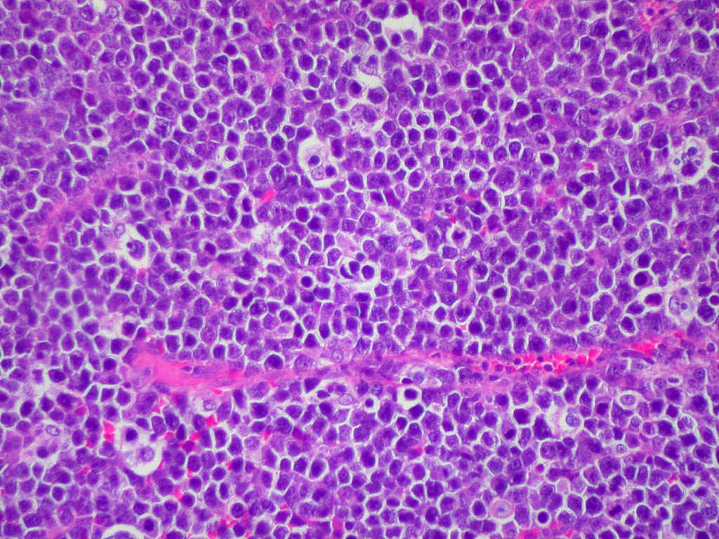 Burkitt lymphoma starry sky