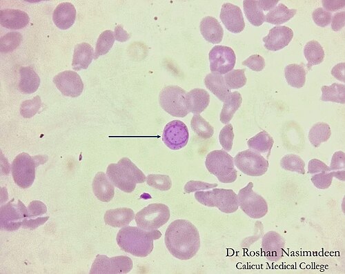 Peripheral smear showing basophilic stippling with blue dots in red cells from lead poisoning