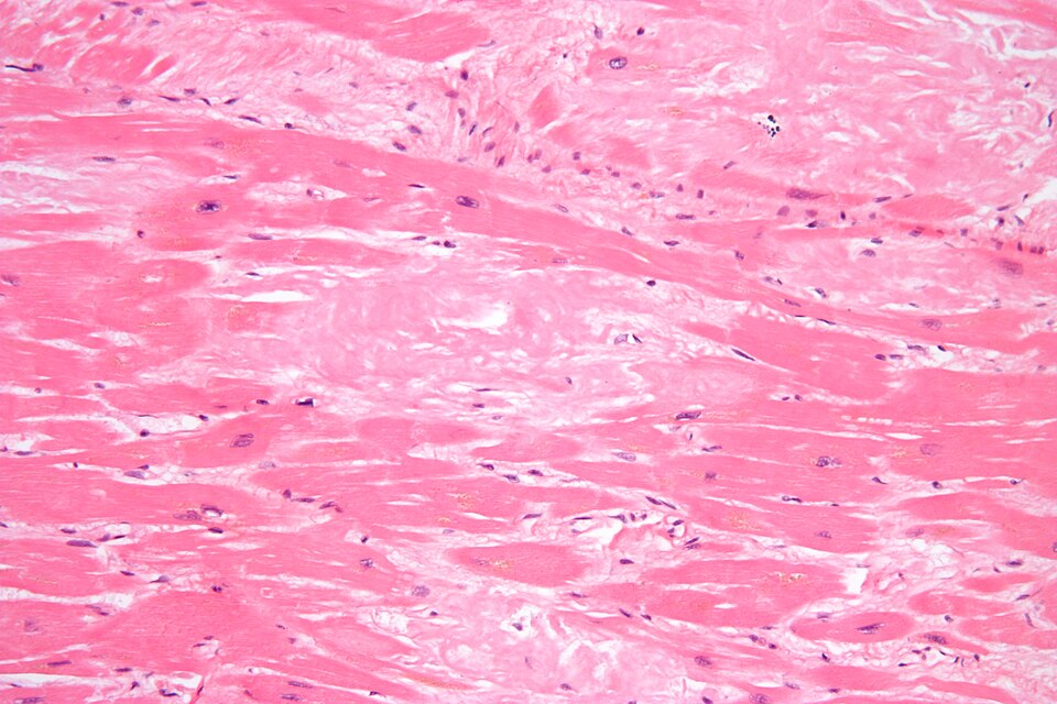 Cardiac amyloid high magnification