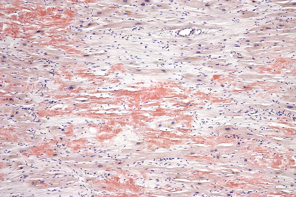 Cardiac amyloidosis histology