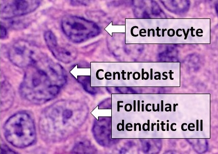Follicular Lymphoma