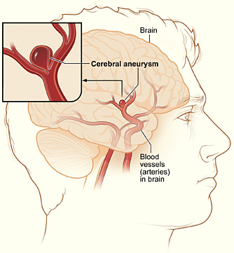 Cerebral aneurysm anatomy illustration from NIH