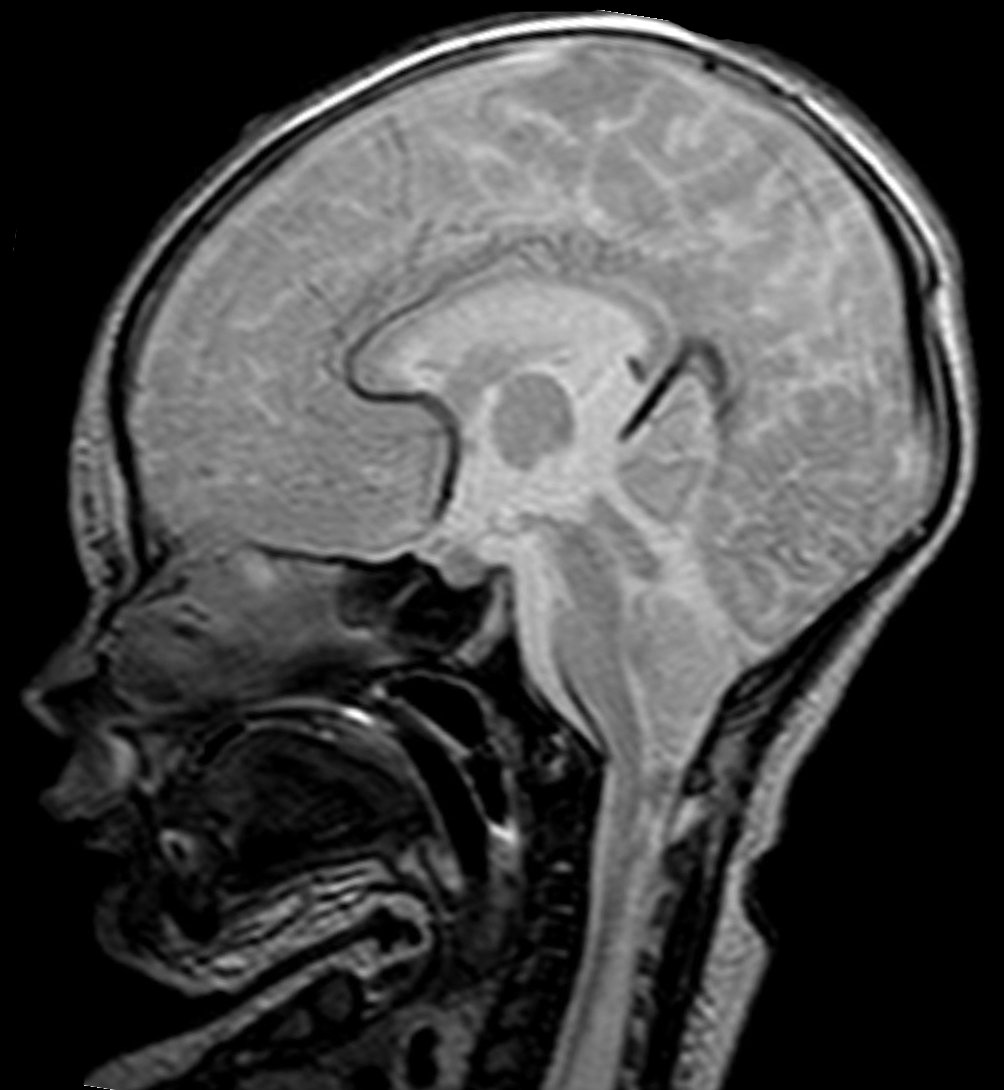 T2 sagittal MRI of a newborn with Chiari II malformation