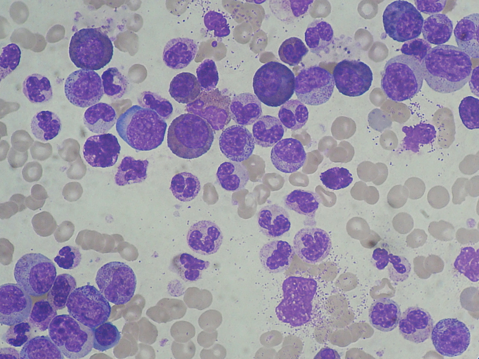 CML peripheral blood smear