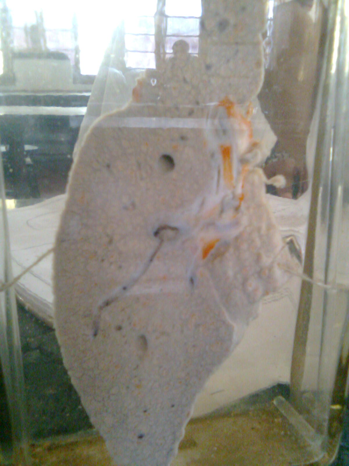 Liver cirrhosis gross specimen