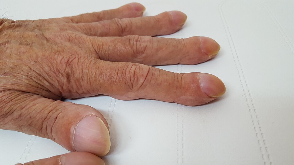 Digital clubbing of the fingers