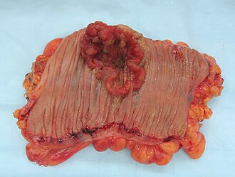 Gross colorectal carcinoma specimen