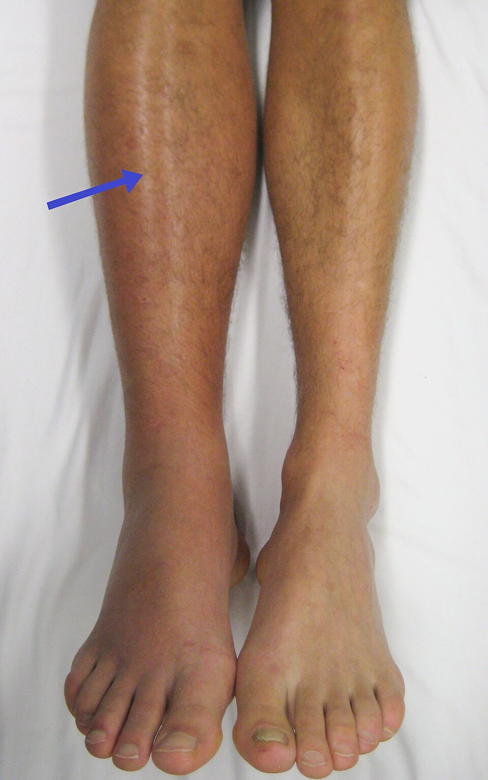 Swollen erythematous right leg of deep vein thrombosis
