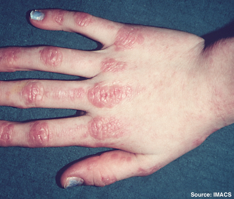 Heliotrope rash on eyelids in dermatomyositis