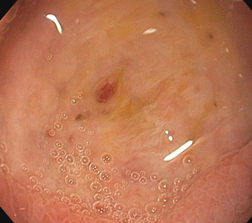 Peptic ulcer endoscopy