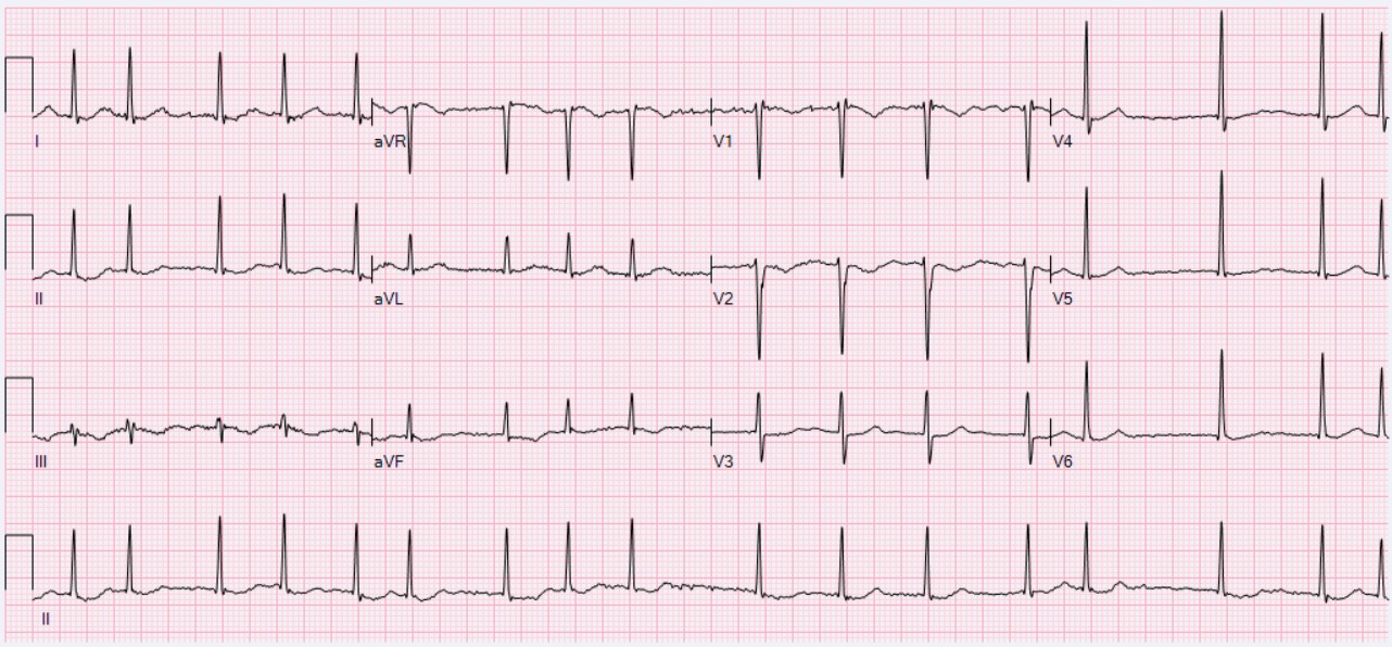 Atrial fibrillation ECG tracing irregular baseline