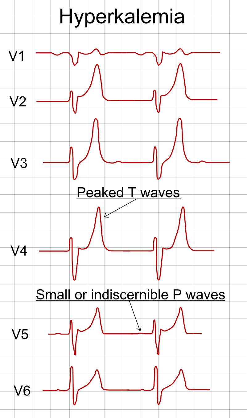 Diagram of ECG changes across rising potassium levels