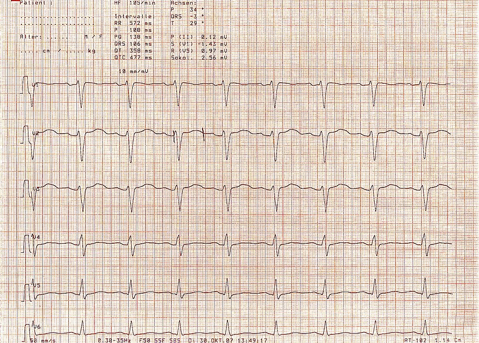 ECG showing prolonged QT interval