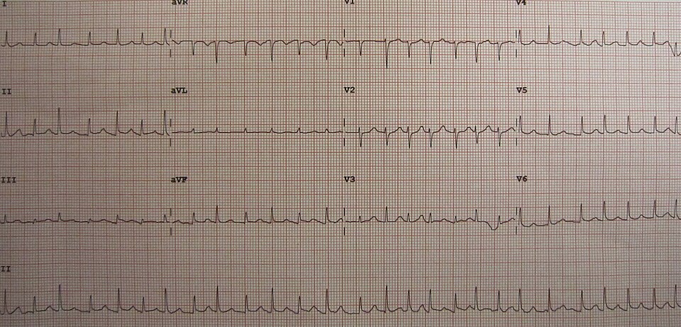 ECG electrical alternans