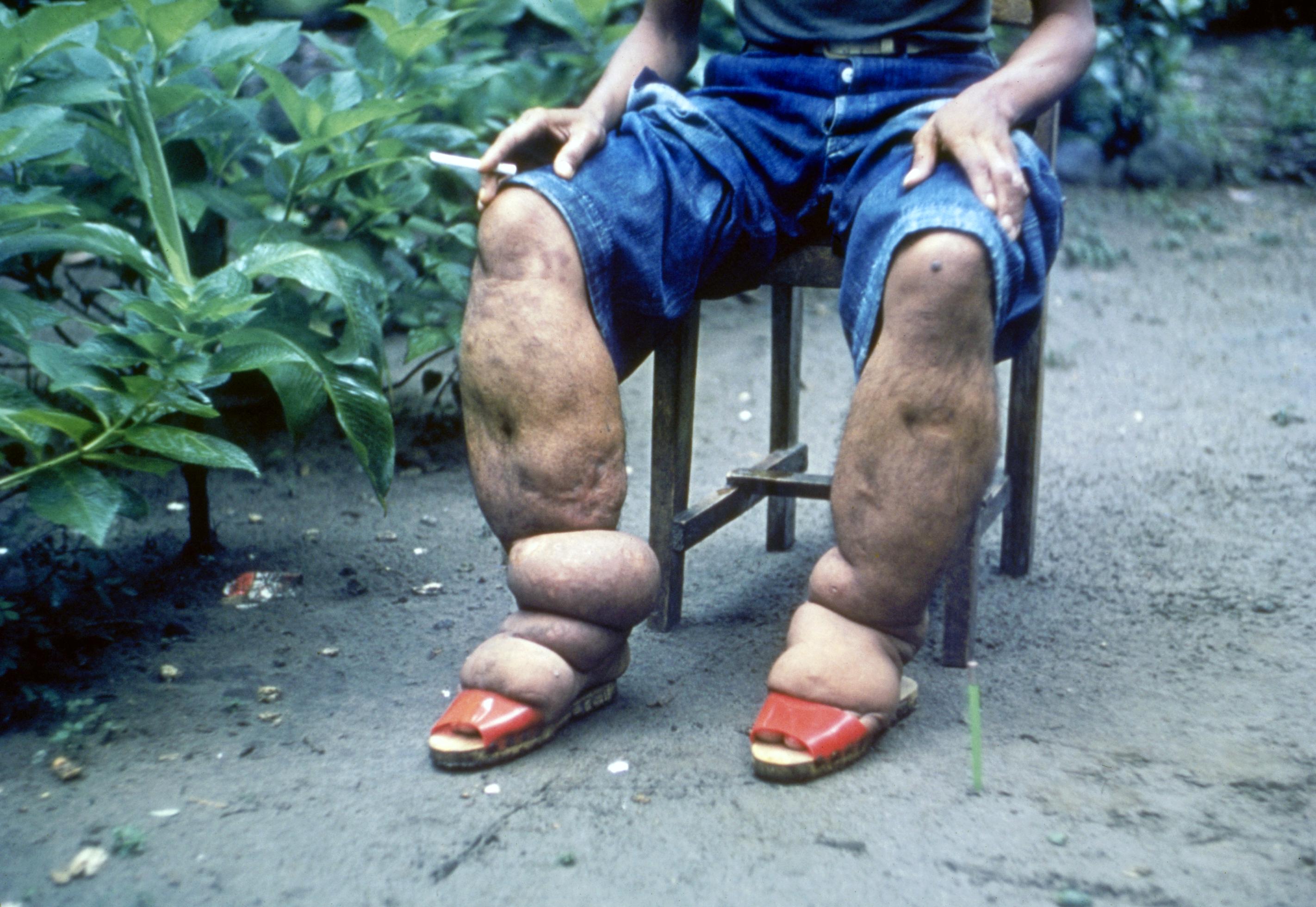 Marked elephantiasis of the lower limb due to lymphatic filariasis