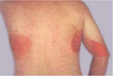 Radiation burn from fluoroscopy overexposure