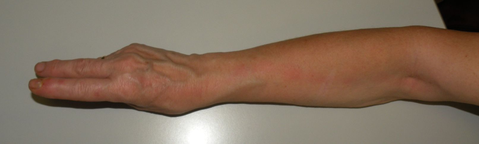 Red linear streak ascending the forearm from a hand infection, consistent with lymphangitis