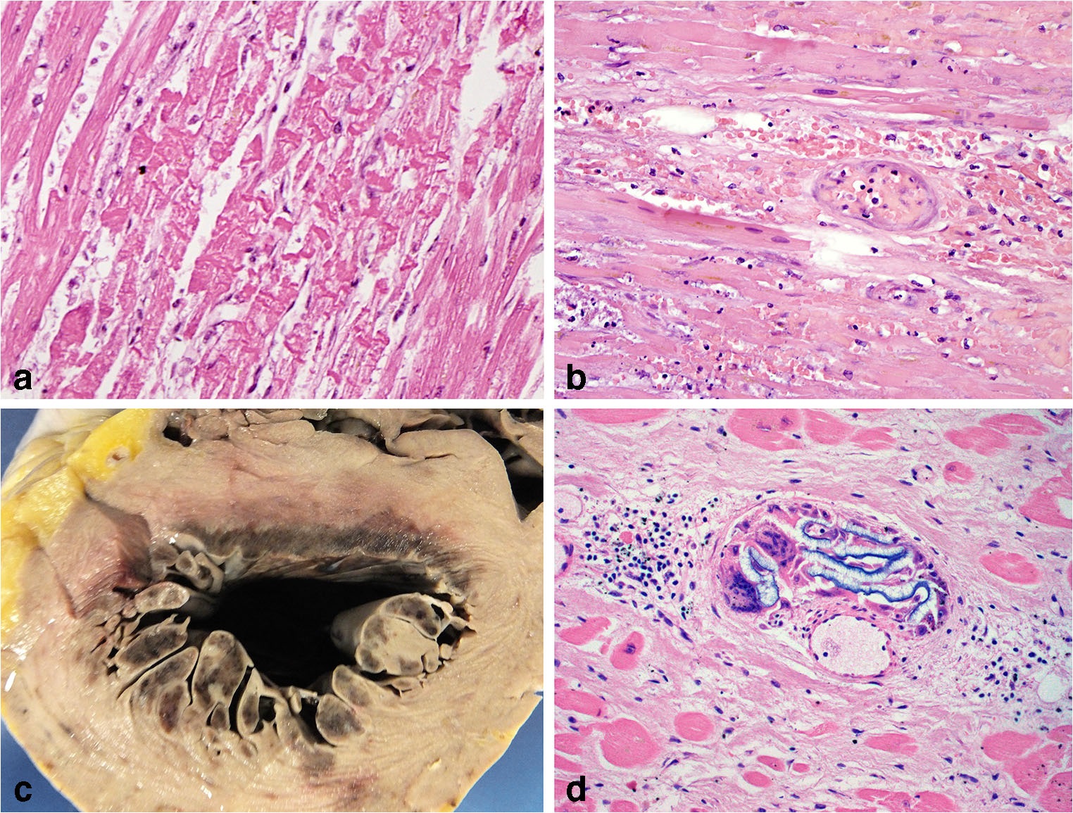 Reperfusion injury histology