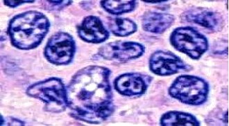 Follicular lymphoma histology with centrocytes