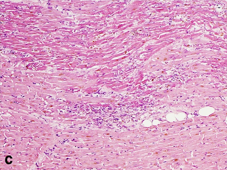 Coagulative necrosis histology