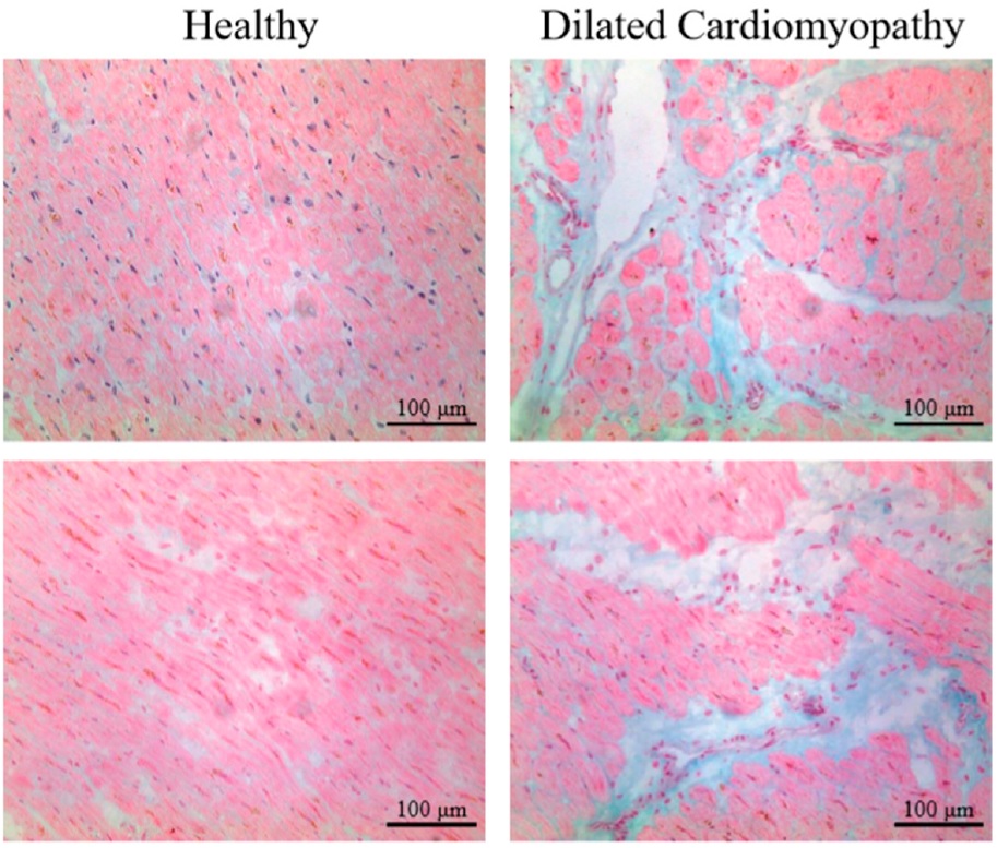 Interstitial fibrosis in DCM