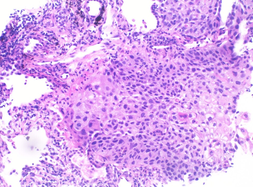 Squamous cell carcinoma histology