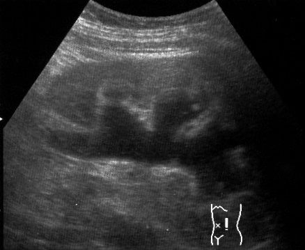 Hydronephrosis on ultrasound