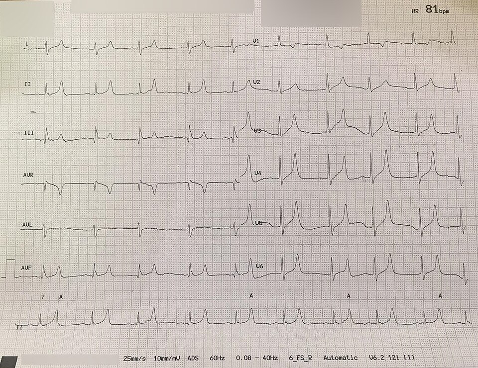ECG showing hyperkalemia with peaked T waves