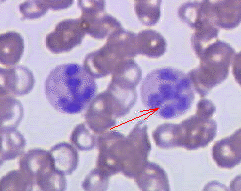 Hypersegmented neutrophil in megaloblastic anemia