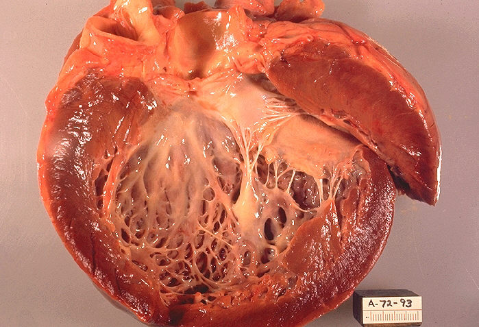 Dilated cardiomyopathy gross pathology