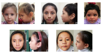 Turner syndrome phenotype