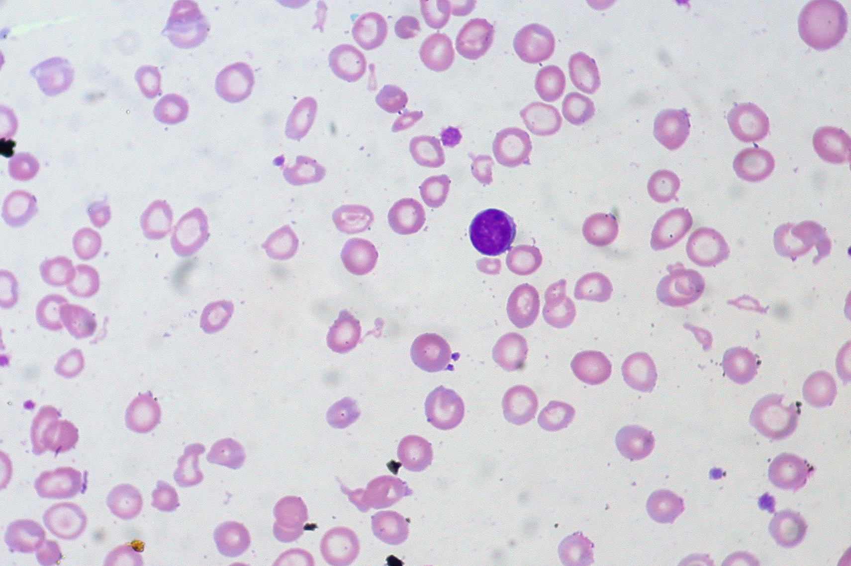 IDA peripheral blood smear