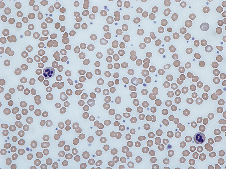 Peripheral blood smear showing hypochromic microcytic red cells in iron deficiency anemia