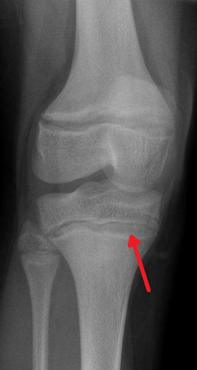 Dense metaphyseal lead lines on knee X-ray