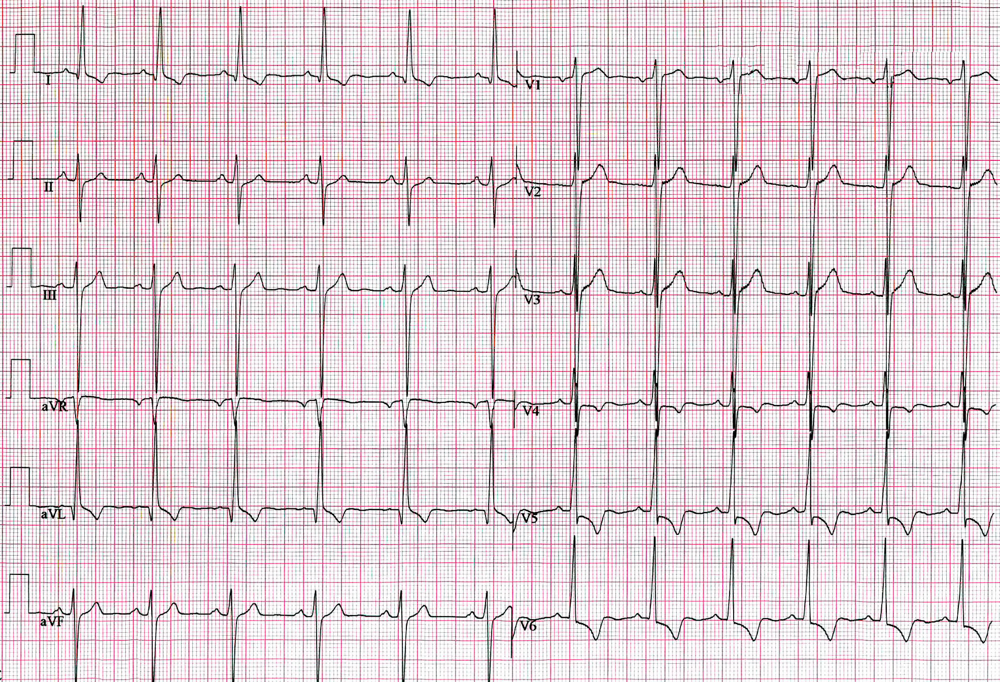 Electrocardiogram showing tall QRS voltages consistent with left ventricular hypertrophy