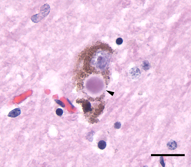 Lewy body in the substantia nigra, H&E stain