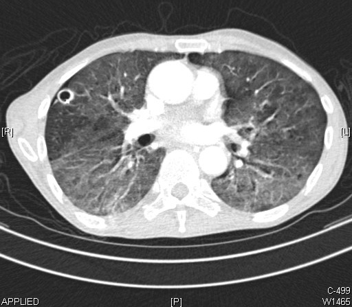 Lung abscess CT scan showing cavitary lesion