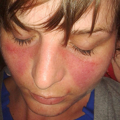 Malar butterfly rash in SLE