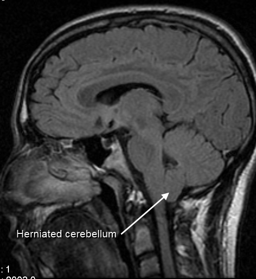 Sagittal MRI showing a Type 1 Arnold-Chiari malformation with herniated cerebellar tonsils