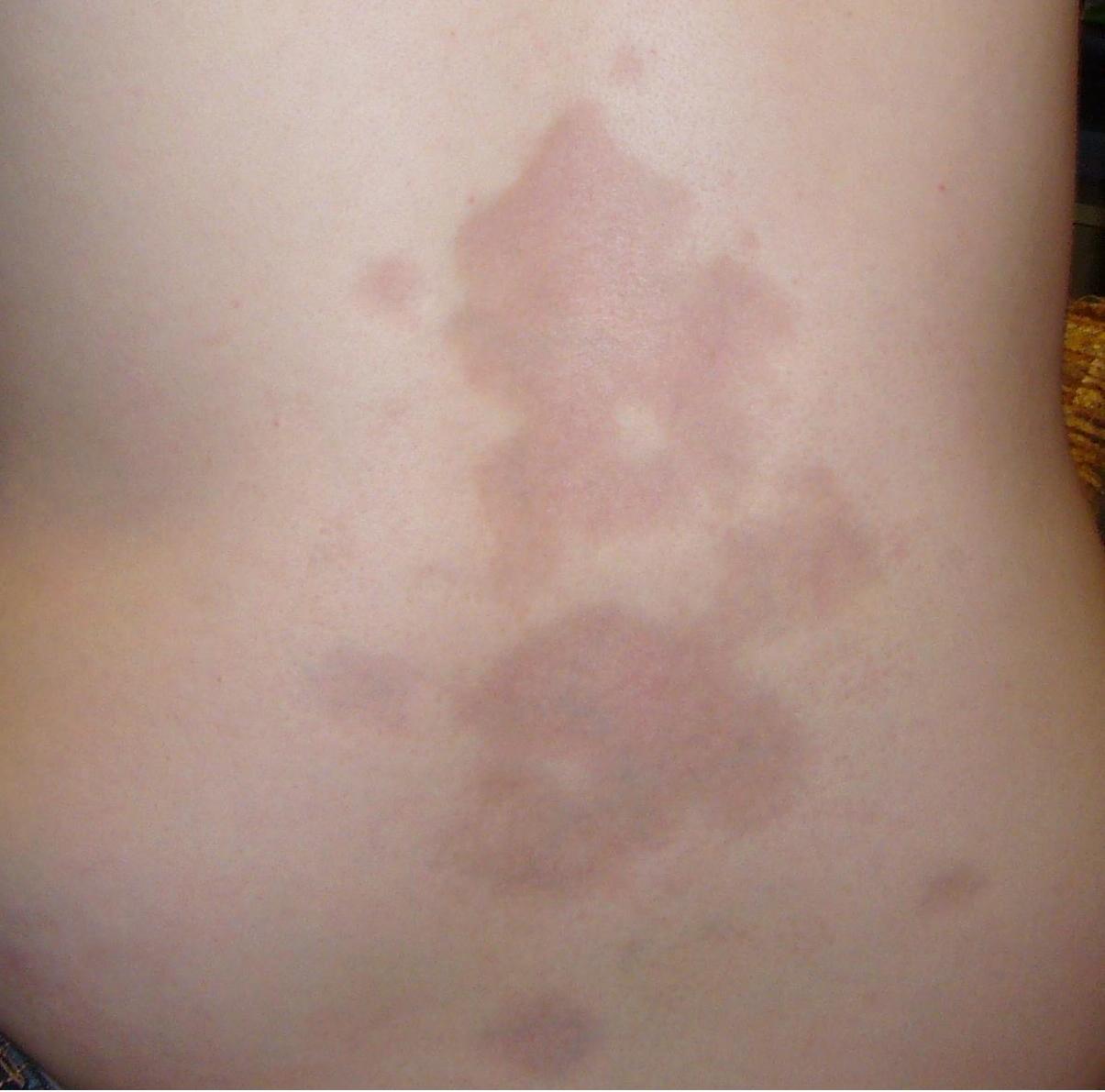Sclerodactyly in scleroderma