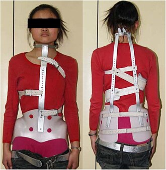 TLSO brace for scoliosis