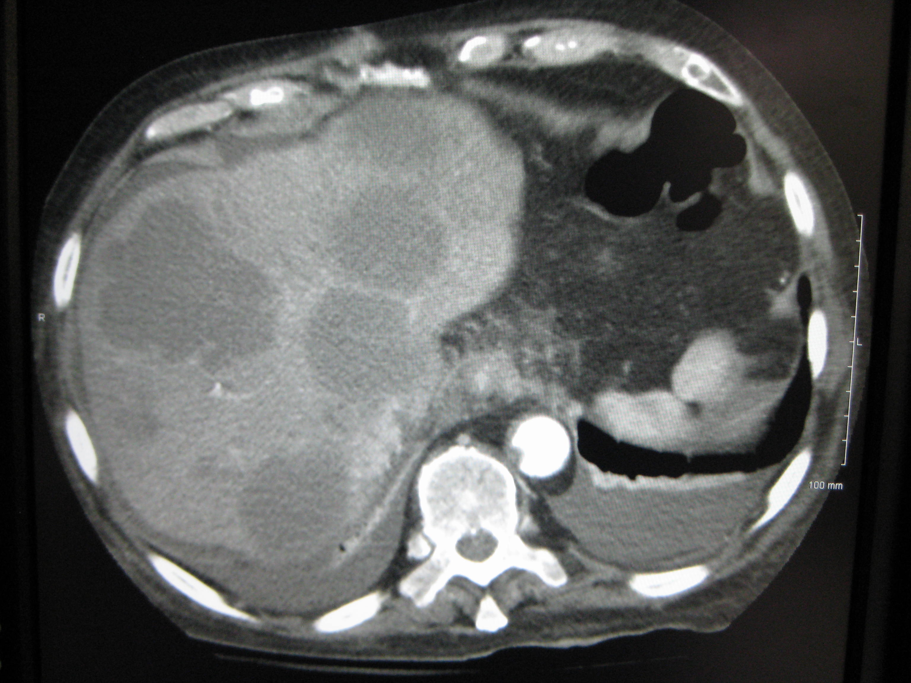 CT scan showing multiple liver metastases