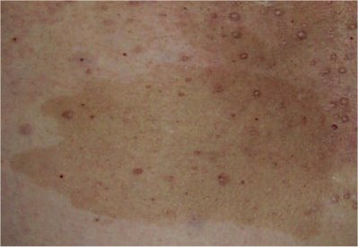 Cafe au lait macule on the skin of a patient with neurofibromatosis type 1