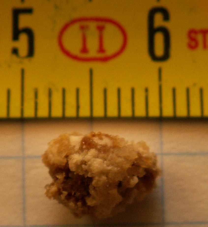 Ureteral stone on CT