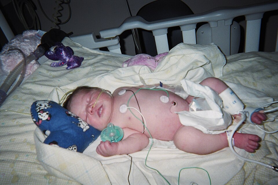 Neonate in the NICU with monitoring lines, where pulse oximetry is performed before discharge