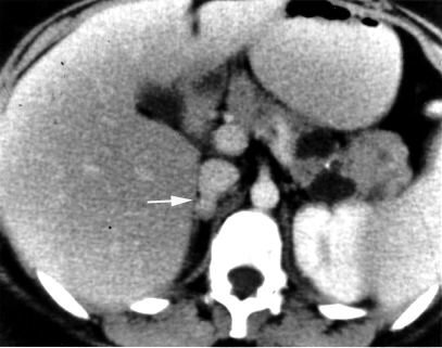 Pheochromocytoma gross specimen of the adrenal medulla